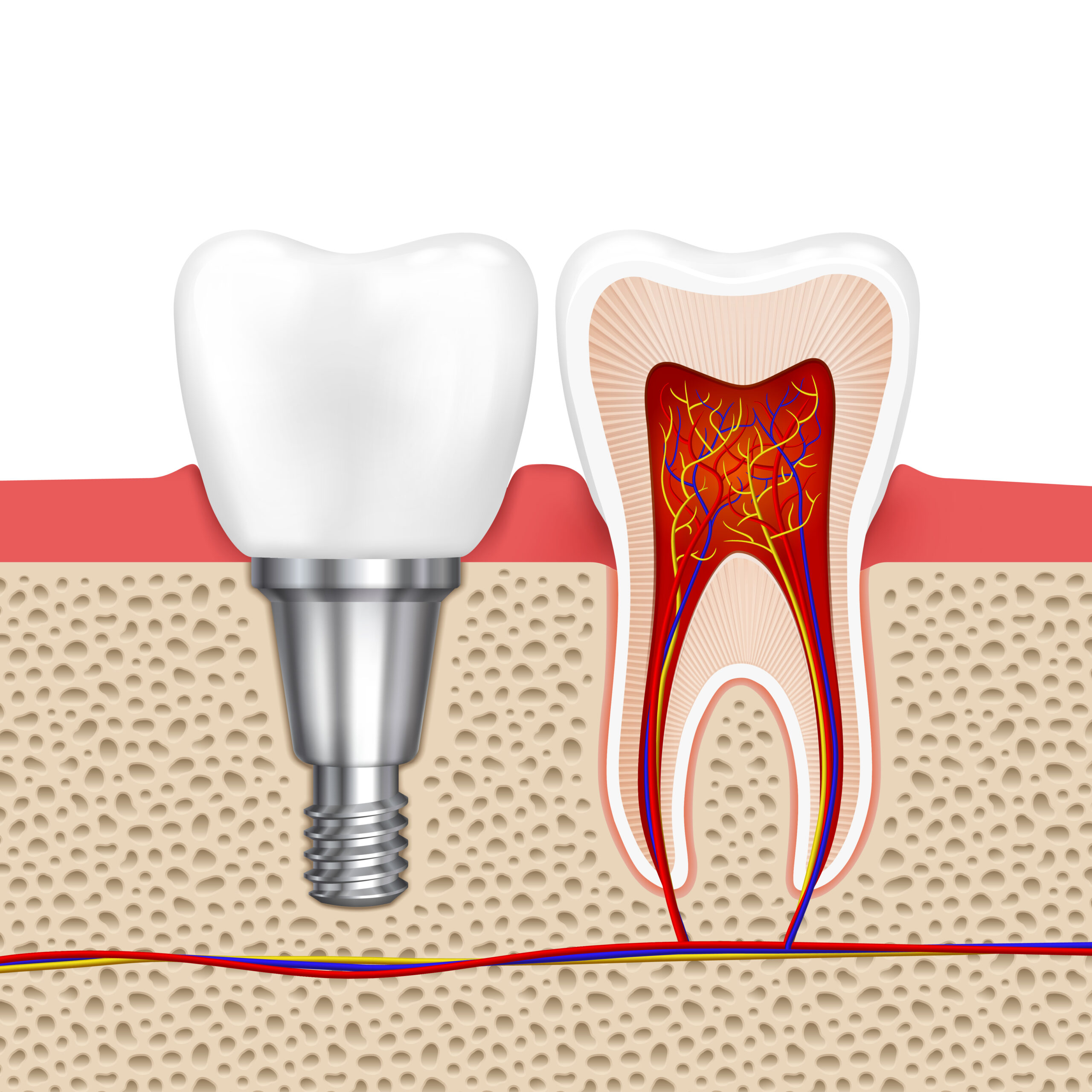 Single Tooth Replacement With Dental Implant