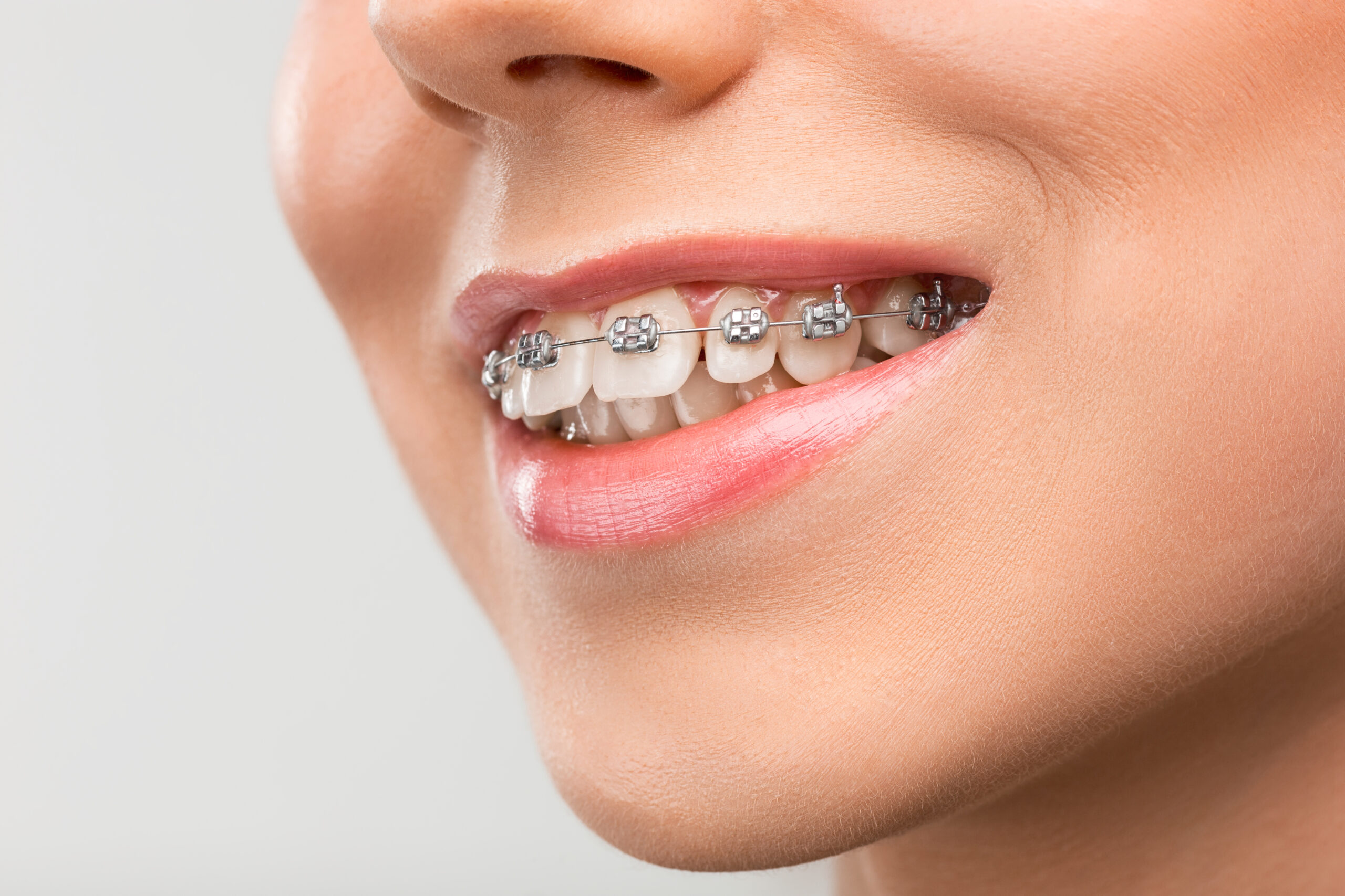 Surgical Orthodontics treatment In Hyderabad