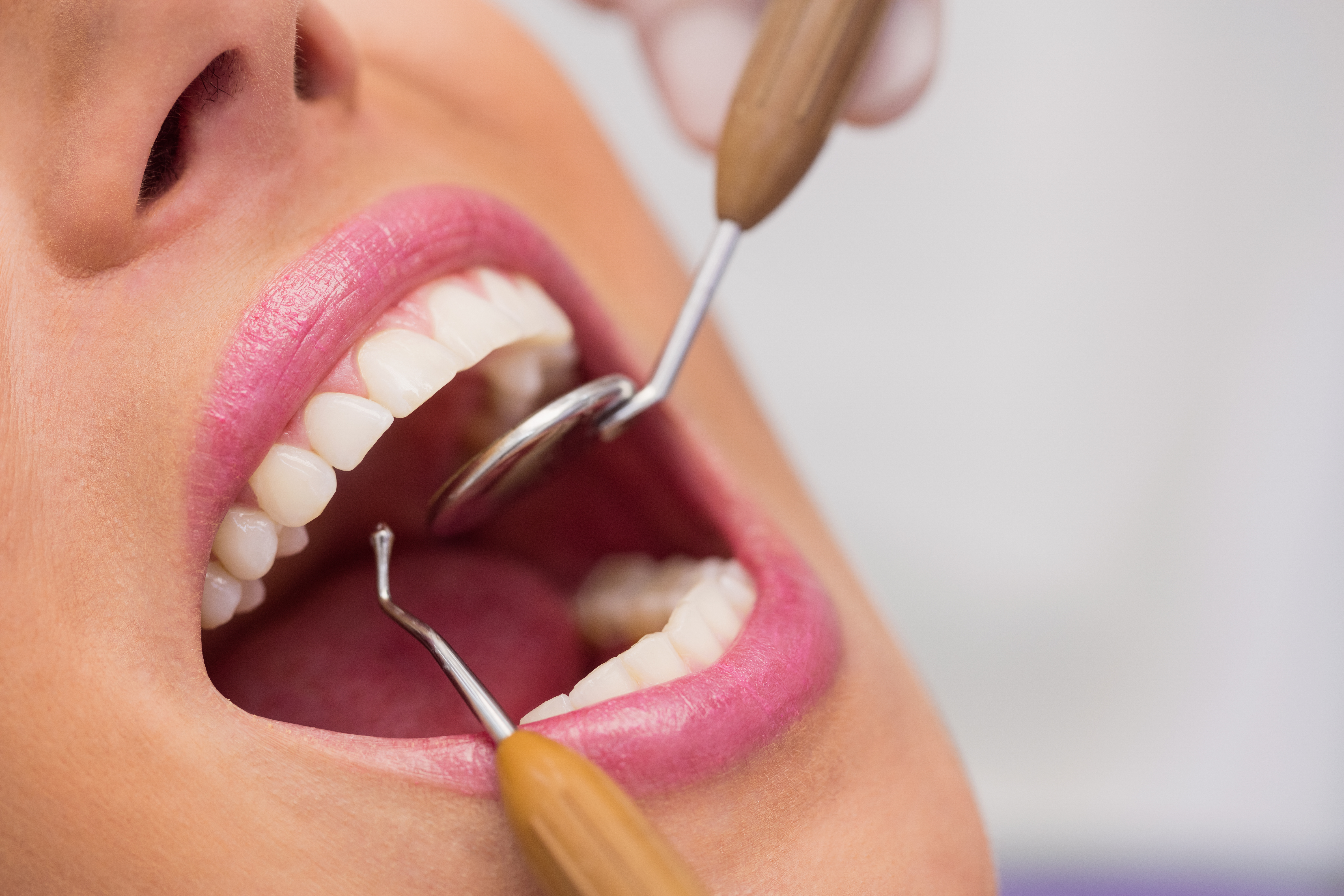 Extraction of Teeth Treatment In Hyderabad